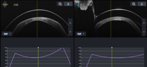 Keratoconus OCT